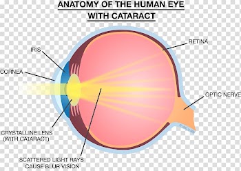 Light Eye Lens Strength Training Anatomy Cataract, light transparent background PNG clipart