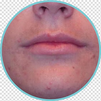 Light therapy Acne Face Skin, acne transparent background PNG clipart