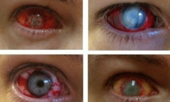 Low Cost Contact Lenses Pose Dangers |