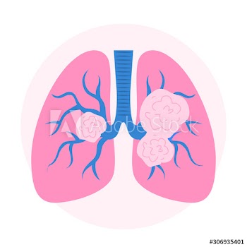 Lung cancer signs