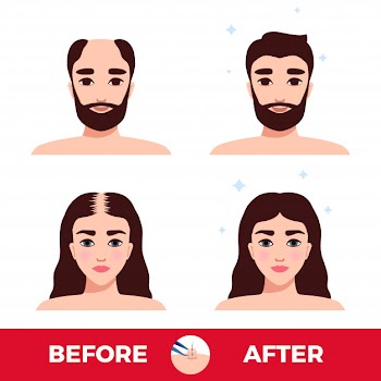 Man and woman before and after hair transplantation on white Free Vector