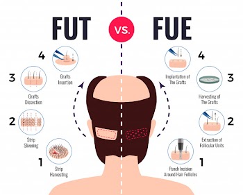 Methods of hair transplantation fut vs fue poster with infographic elements on white Free Vector