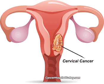Minimally Invasive surgery leads to worse survival of cervical ...