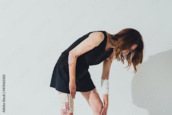 表皮水泡症の女性のポートレート