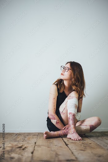 表皮水泡症の女性のポートレート