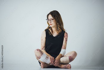 表皮水泡症の女性のポートレート
