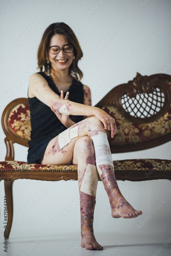 表皮水泡症の女性のポートレート
