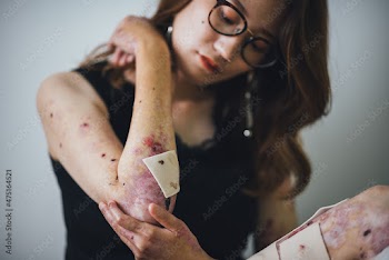 表皮水泡症の女性のポートレート