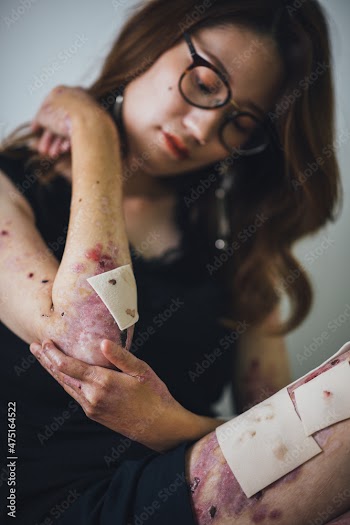 表皮水泡症の女性のポートレート