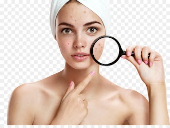 Pimple Acne Benzoyl peroxide Therapy Skin - powder effect 