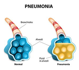 Pneumonia Patient PNG Transparent Pneumonia Patient.PNG Images ...
