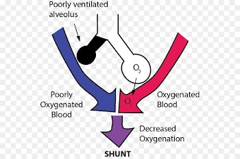 Pulmonary shunt Lung Ventilation/perfusion ratio Ventilation perfusion mismatch - anesthesiologist pictogram 