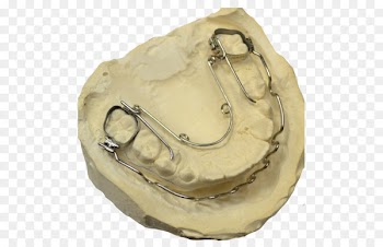 Quad helix Orthodontics Jaw Moscow Orthodontic Laboratory - others 