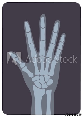 Radiograph, X-radiation picture or X-ray image of hand or palm with wrist and fingers