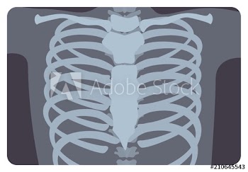 Radiograph, X-radiation picture or X-ray image of rib or thoracic cage formed by vertebral column and sternum
