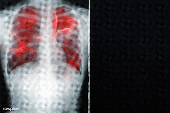 Respiratory tract infection shown on x-ray due to coronavirus  | Free  illustration - 2312524