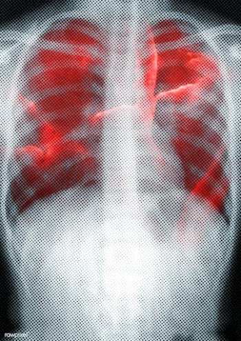 Respiratory tract infection shown on x-ray due to coronavirus  | Free  illustration - 2312532