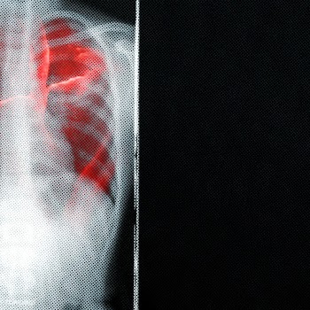 Respiratory tract infection shown on x-ray due to coronavirus  | Free  illustration - 2312550