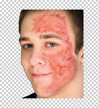Scarred Burn Scar Contracture Face PNG, Clipart, Bruise, Burn ...