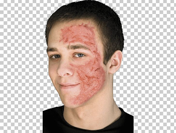 Scarred Burn Scar Contracture Face PNG, Clipart, Burn, Burn Scar ...