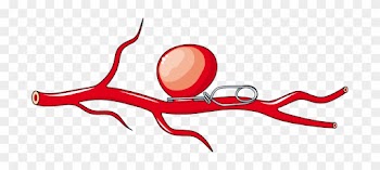Servier Medical Art - Aneurysm Clip Art