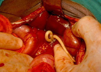 Soil-transmitted helminthiasis - Wikipedia