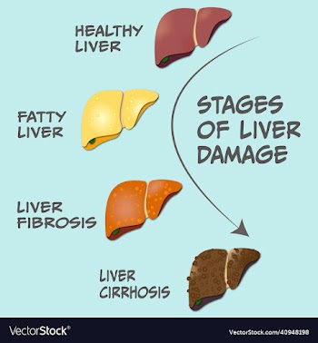 stages of liver damage
