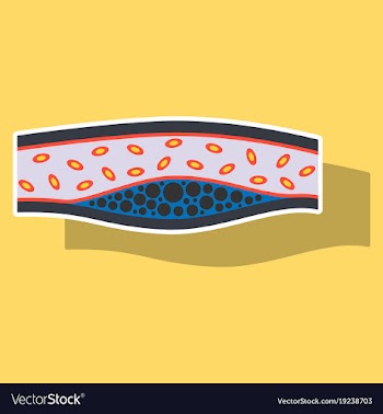 Sticker vienna human atherosclerosisthe structure vector image