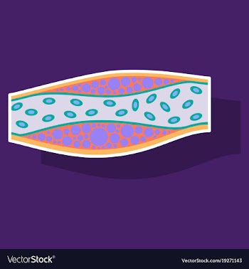Sticker vienna human atherosclerosisthe structure vector image