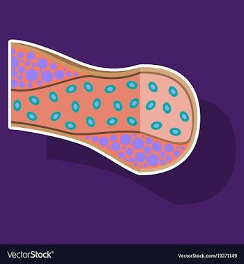 Sticker vienna human atherosclerosisthe structure vector image