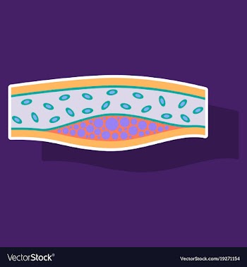 Sticker vienna human atherosclerosisthe structure vector image