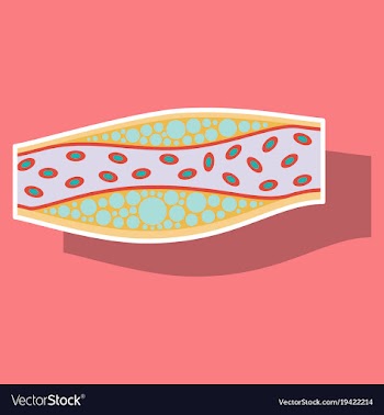 Sticker vienna human atherosclerosisthe structure vector image