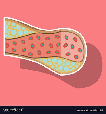 Sticker vienna human atherosclerosisthe structure vector image