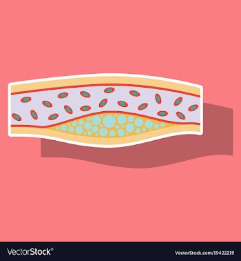 Sticker vienna human atherosclerosisthe structure vector image