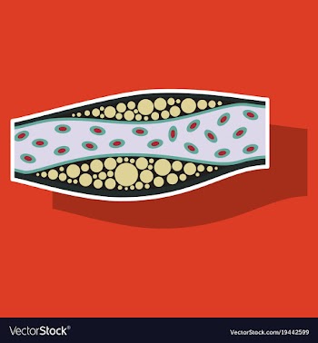 Sticker vienna human atherosclerosisthe structure vector image