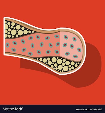 Sticker vienna human atherosclerosisthe structure vector image