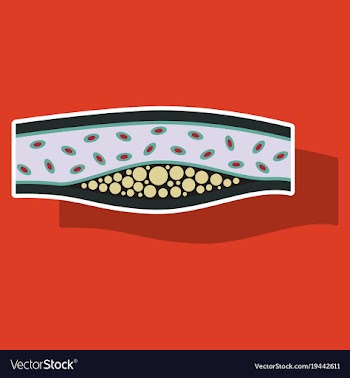 Sticker vienna human atherosclerosisthe structure vector image