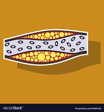 Sticker vienna human atherosclerosisthe structure vector image