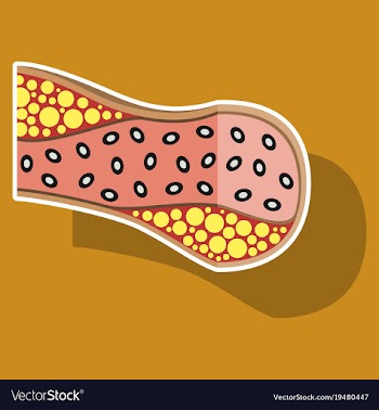Sticker vienna human atherosclerosisthe structure vector image