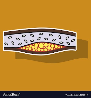 Sticker vienna human atherosclerosisthe structure vector image