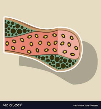 Sticker vienna human atherosclerosisthe structure vector image