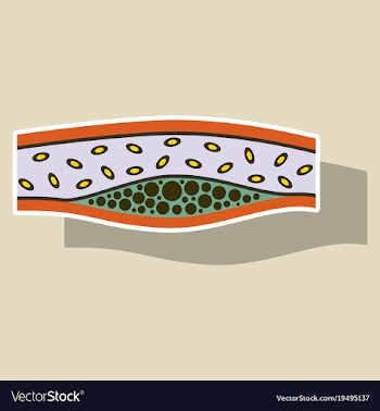 Sticker vienna human atherosclerosisthe structure vector image