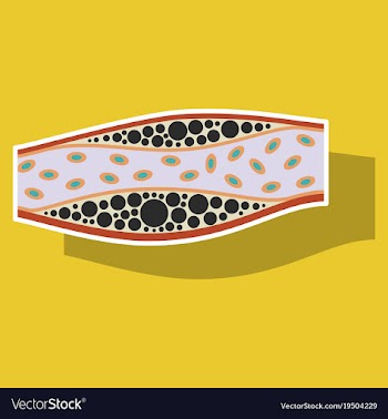 Sticker vienna human atherosclerosisthe structure vector image