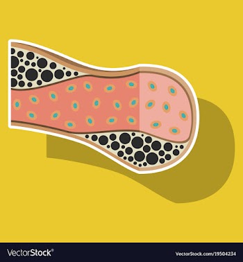 Sticker vienna human atherosclerosisthe structure vector image