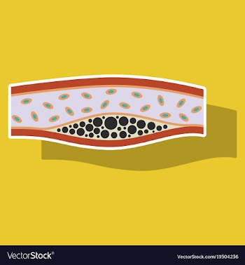 Sticker vienna human atherosclerosisthe structure vector image