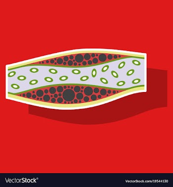 Sticker vienna human atherosclerosisthe structure vector image