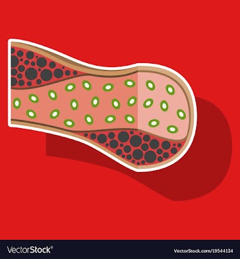 Sticker vienna human atherosclerosisthe structure vector image