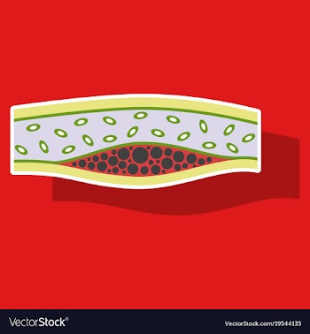 Sticker vienna human atherosclerosisthe structure vector image
