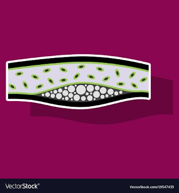 Sticker vienna human atherosclerosisthe structure vector image