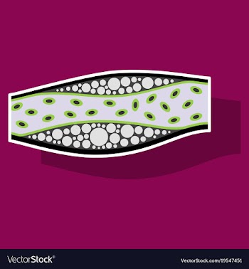 Sticker vienna human atherosclerosisthe structure vector image